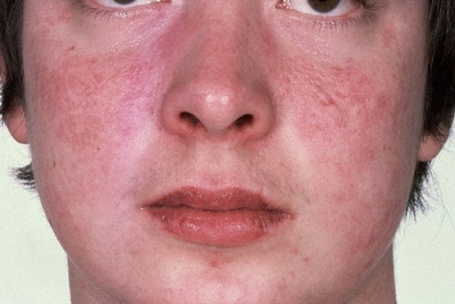 Những dấu hiệu của bệnh lupus ban đỏ bạn cần lưu &yacute;