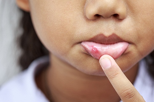 Những dấu hiệu của bệnh lupus ban đỏ bạn cần lưu &yacute;