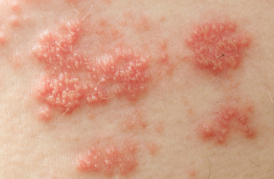 Những dấu hiệu của bệnh lupus ban đỏ bạn cần lưu &yacute;