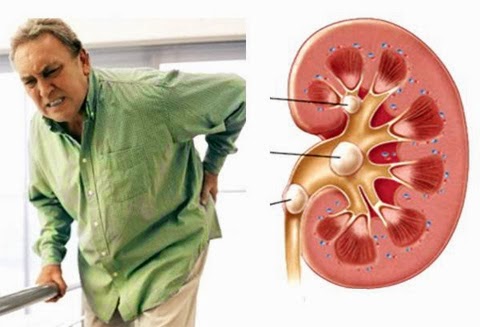 có nhiều bài thuốc dân gian chữa bệnh sỏi thận đơn giản mà không cần sử dụng đến dao kéo, lại đỡ tốn kém