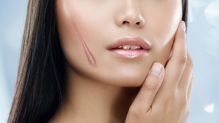 Vết sẹo mầm mống của bệnh ung thư da 