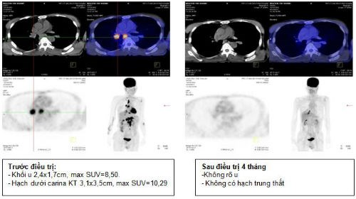 Ph&aacute;t minh mới về thuốc nhắm tr&uacute;ng đ&iacute;ch gi&uacute;p điều trị bệnh ung thư phổi