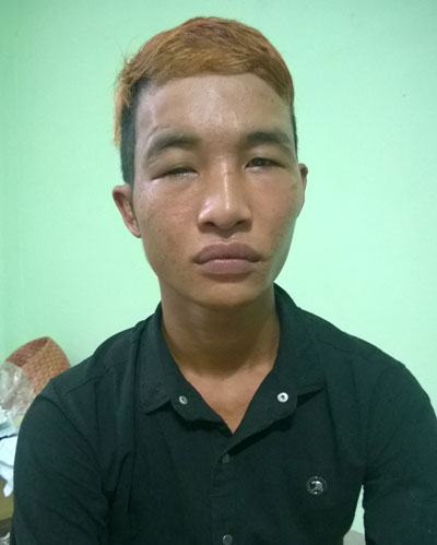 Hào Anh, với mắt trái bị bệnh, theo bác sĩ là nguy hiểm đến thị lực. 