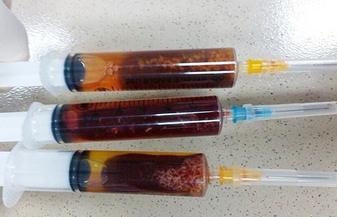 S&aacute;n chui v&agrave;o tim do ăn đồ ăn sống