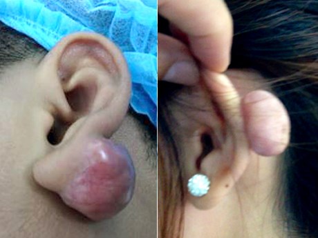 bấm lỗ tai g&acirc;y hại