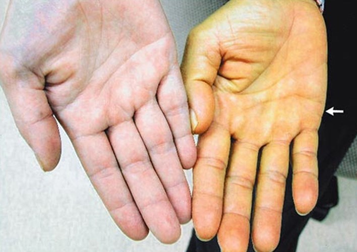 Dấu hiệu ung thư dễ nhận biết ở nam giới l&agrave; thay đổi m&agrave;u da