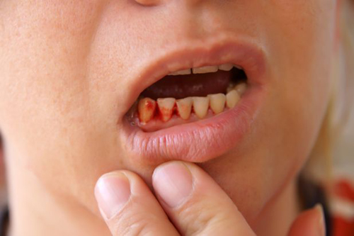 Xỉa răng bằng tăm g&acirc;y hại cho lợi v&agrave; xương