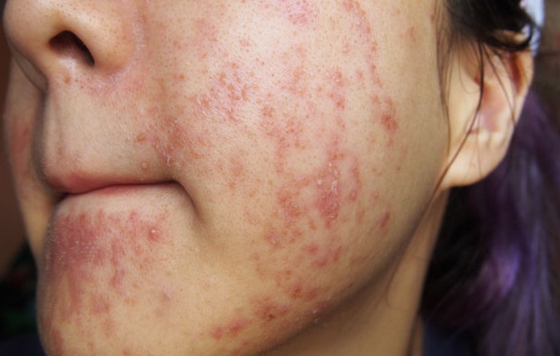Cảnh gi&aacute;c những nguy hại kh&ocirc;ng lường từ kem l&agrave;m trắng da cấp tốc