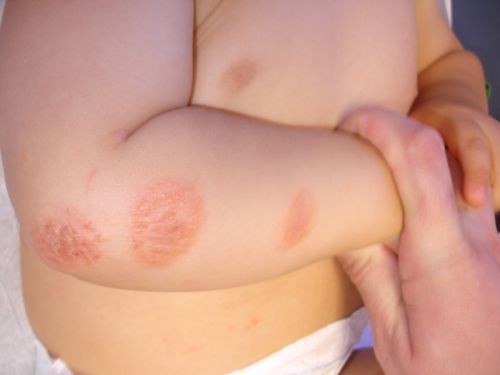 Miếng d&aacute;n chống muỗi g&acirc;y nguy hại cho trẻ