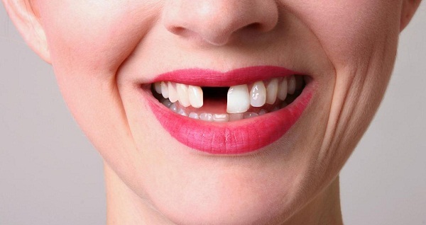 Ham rẻ l&agrave;m răng sứ k&eacute;m chất lượng cẩn thận hỏng cả h&agrave;m răng