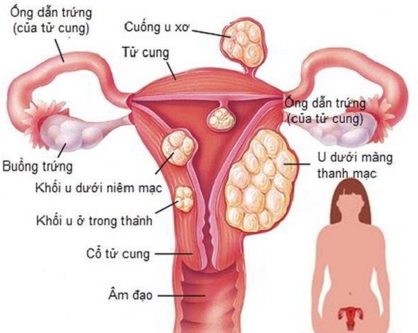 Phụ nữ trẻ tuổi: Đừng để mắc u xơ tử cung v&igrave; những m&oacute;n ăn quen thuộc n&agrave;y