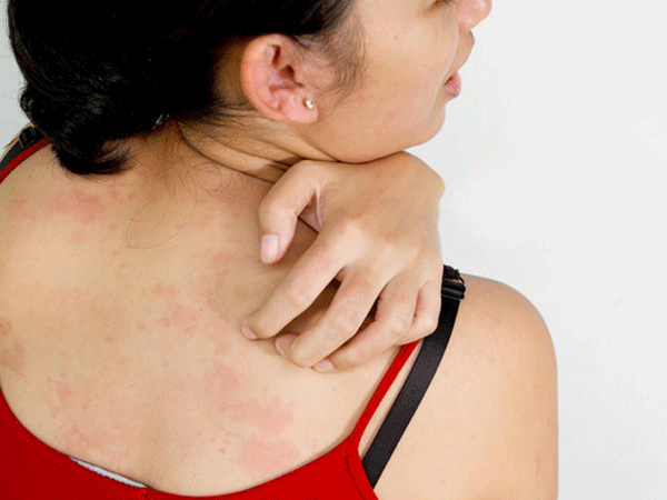 Ngứa da c&oacute; thể l&agrave; biểu hiện của nhiều bệnh nguy hiểm
