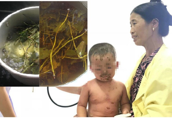 Sử dụng c&aacute;c loại l&aacute; kh&ocirc;ng r&otilde; đặc t&iacute;nh để tắm cho trẻ c&oacute; thể l&agrave;m trầm trọng bệnh