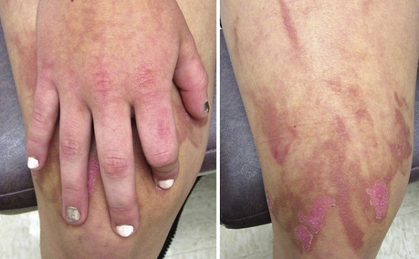 Một b&eacute; g&aacute;i 13 tuổi bị bỏng r&aacute;t ở phần da d&iacute;nh nước chanh sau khi pha sinh tố