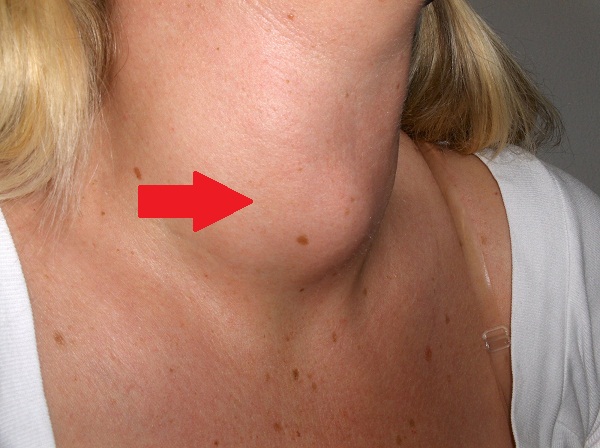 Thiếu i-ốt l&agrave;m giảm khả năng hoạt động của tuyến gi&aacute;p g&acirc;y bướu cổ