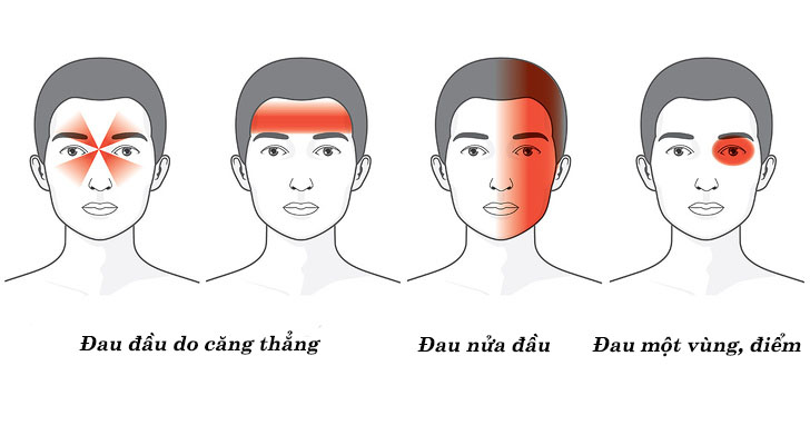  Nhức đầu thường gặp bao gồm căng thẳng, đau nửa đầu v&agrave; đau một v&ugrave;ng. Ảnh: &copy; depositphotos.com  Nhức đầu thường gặp bao gồm căng thẳng, đau nửa đầu v&agrave; đau một v&ugrave;ng. Ảnh: &copy; depositphotos.com 