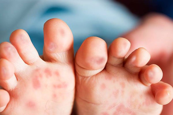 Những bệnh thường gặp nhất v&agrave;o m&ugrave;a h&egrave; cần biết để tr&aacute;nh