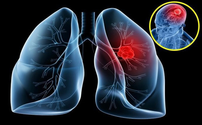 Ung thư phổi: 7 nguy&ecirc;n nh&acirc;n g&acirc;y bệnh &iacute;t người ngờ tới