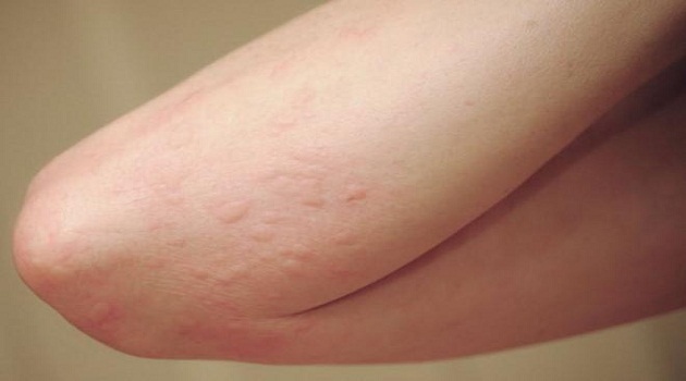 Hiện nay, ung thư gan ở Việt Nam chiếm tỉ lệ cao nhất trong c&aacute;c loại ung thư