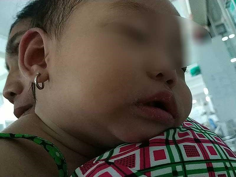 Trẻ bị sốt, ho đừng coi thường bởi c&oacute; thể l&agrave; dấu hiệu của bệnh Kawasaki