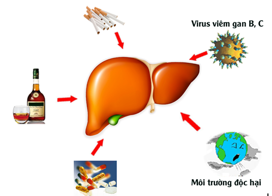 Bệnh xơ gan l&agrave; căn bệnh nguy hiểm do nhiều nguy&ecirc;n nh&acirc;n g&acirc;y n&ecirc;n