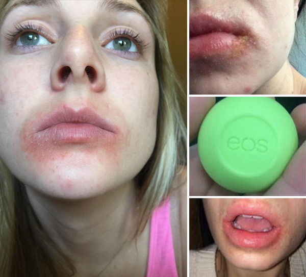 Son trứng EOS bị kiện do g&acirc;y ra dị ứng, phồng rộp, nứt nẻ, chảy m&aacute;u cho người sử dụng