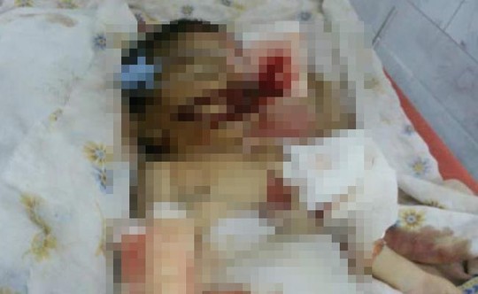 Một vụ tai nạn hy hữu tương tự khiến b&eacute; 10 ng&agrave;y tuổi bị chuột cắn chết từng xảy ra trong bệnh viện ở Ấn Độ