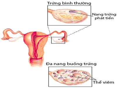 Thuốc tr&aacute;nh thai c&oacute; t&aacute;c dụng hỗ trợ điều trị hội chứng buồng trứng đa nang