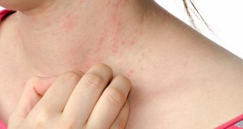 Da bị ph&aacute;t ban, k&iacute;ch ứng mạnh cũng l&agrave; dấu hiệu của ung thư da