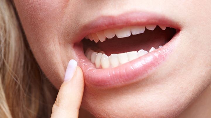 Ung thư miệng c&oacute; nguy cơ r&otilde; rệt đối với người ở độ tuổi sau 40