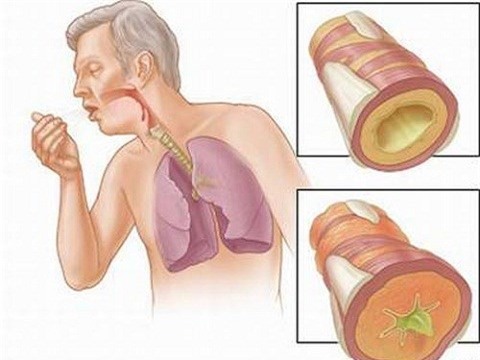 Một trong những dấu hiệu đ&aacute;ng ch&uacute; &yacute; của bệnh ung thư phổi l&agrave; ho dai dẳng