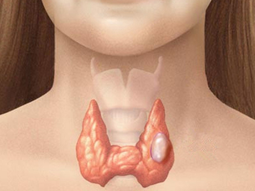 Ung thư tuyến gi&aacute;p hiện l&agrave; căn bệnh ung thư phổ biến