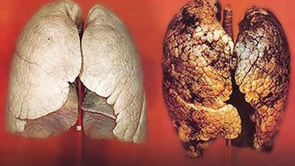 Ung thư phổi c&ograve;n do t&iacute;nh chất c&ocirc;ng việc khi h&iacute;t phải nhiều loại kh&iacute; c&oacute; hại
