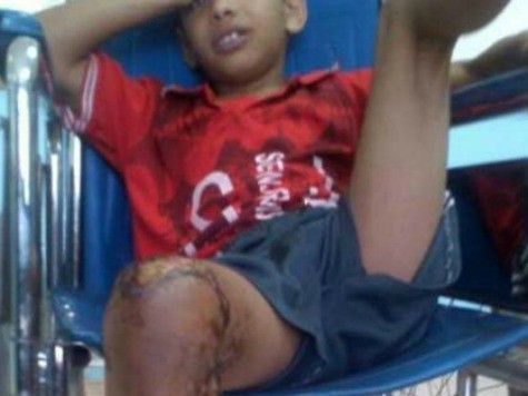 Cậu b&eacute; 10 tuổi người Yemen bị bỏng một ch&acirc;n sau tr&ograve; đ&ugrave;a của một nh&oacute;m thiếu ni&ecirc;n trong l&agrave;ng