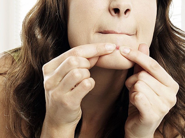 Mụn trứng c&aacute; c&oacute; thể xuất hiện bất cứ vị tr&iacute; n&agrave;o tr&ecirc;n mặt