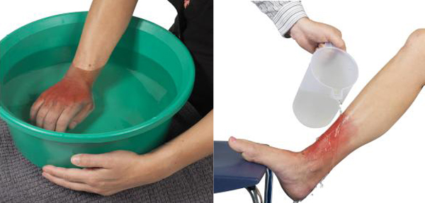 Cần nhanh ch&oacute;ng l&agrave;m m&aacute;t v&ugrave;ng da bị bỏng