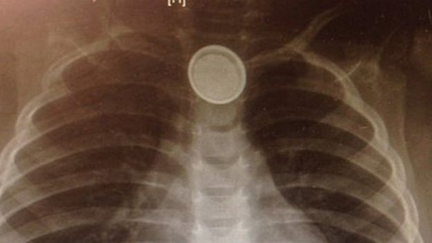  Pin c&uacute;c &aacute;o g&acirc;y tắc cổ họng cho trẻ