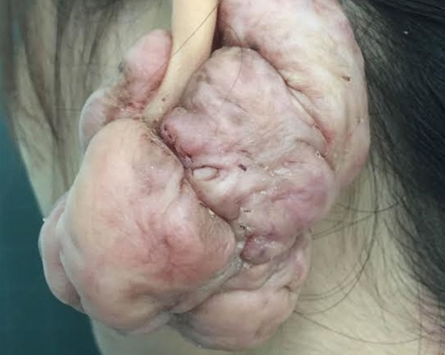 Sẹo lồi kinh ho&agrave;ng sau khi chị A đi bấm lỗ tai