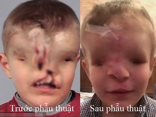 Khu&ocirc;n mặt trước v&agrave; sau phẫu thuật của em b&eacute; dị dạng Yahya