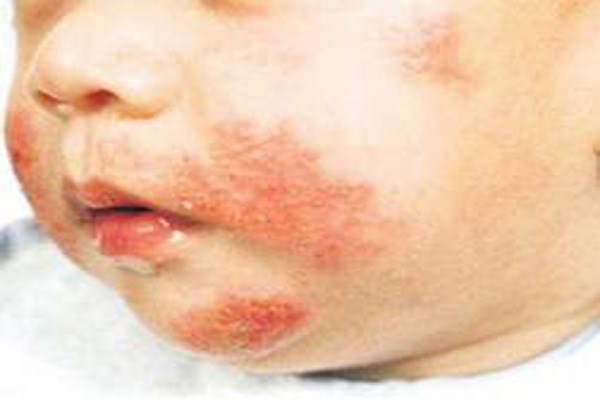 Da trẻ sơ sinh thường mỏng v&agrave; dễ nhạy cảm với c&aacute;c t&aacute;c nh&acirc;n ảnh hưởng b&ecirc;n ngo&agrave;i