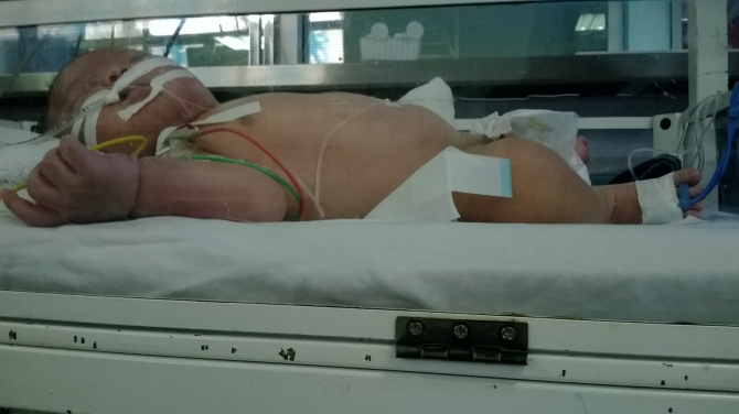 Bé trai 1 tháng tuổi nguy kịch sau khi tiêm thuốc phòng lao Bé Khuất Tiến Minh được điều trị tại khu vực cách ly, các bác sĩ đang chăm sóc rất tích cực.