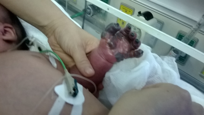 Bé trai 1 tháng tuổi nguy kịch sau khi tiêm thuốc phòng lao Sau khi tiêm phòng lao được ba ngày, các ngón tay trái của bé Minh bị hoại tử và lan dần lên cả cánh tay.