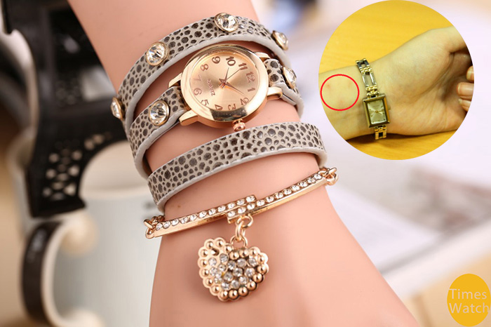 Nhiễm tr&ugrave;ng, lở lo&eacute;t tay v&igrave; đồng hồ trang sức&hellip; rởm