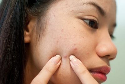  Những người c&oacute; l&agrave;n da bị mụn tuyệt đối kh&ocirc;ng được d&ugrave;ng kem chống nắng. Ảnh minh họa