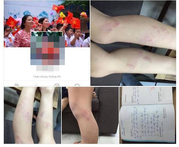  H&igrave;nh ảnh ch&aacute;u Đ.T.M.Đ bị c&ocirc; gi&aacute;o d&ugrave;ng thước đ&aacute;nh th&acirc;m t&iacute;m 2 ch&acirc;n. Ảnh chụp m&agrave;n h&igrave;nh