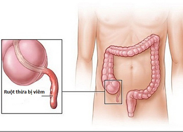 Ruột thừa bị vi&ecirc;m c&oacute; thể vỡ trong v&ograve;ng 24 đến 27 giờ sau khi c&aacute;c triệu chứng bắt đầu xuất hiện. Ảnh minh họa