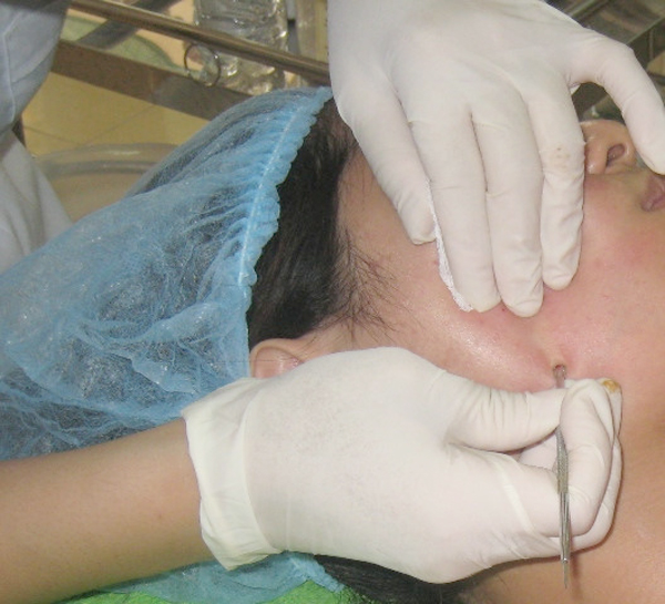 D&ugrave;ng kim nặn mụn c&oacute; rủi ro l&acirc;y nhiễm c&aacute;c t&aacute;c nh&acirc;n g&acirc;y bệnh do l&acirc;y truyền như HIV, vi&ecirc;m gan si&ecirc;u vi... Ảnh minh họa