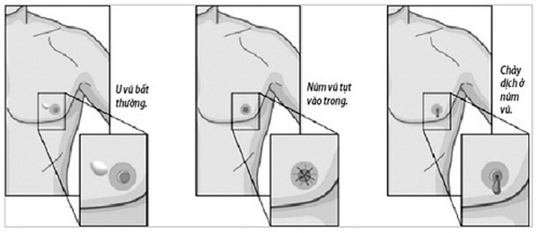 Đừng chủ quan với những dấu hiệu ung thư v&uacute; ở nam giới. Ảnh: Sức khỏe & đời sống