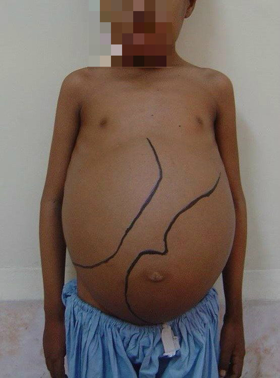 Trẻ bị Thalassemia c&oacute; biến chứng l&ecirc;n gan do ứ sắt ở gan, da, xương... (Ảnh minh họa)