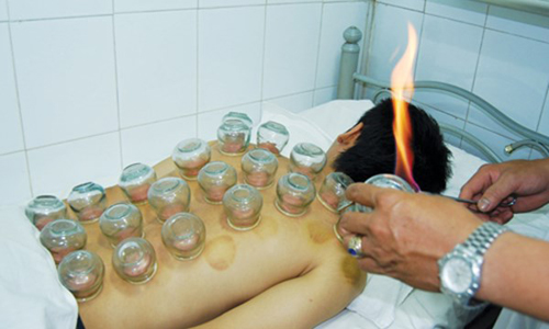 Gi&aacute;c hơi l&agrave; biện ph&aacute;p giải độc cơ thể trong Đ&ocirc;ng y. Ảnh: Sức khỏe & đời sống